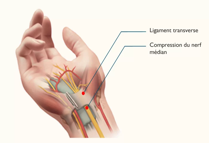 schema du syndrome tunnel carpien