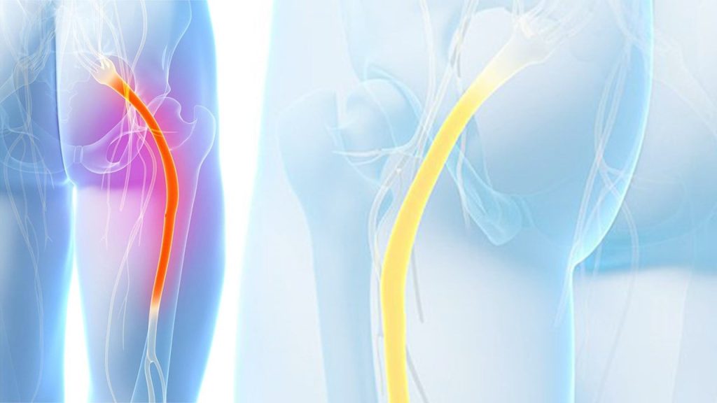 image du nerf sciatique enflamme